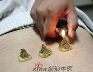 灸法的種類  你知道多少？
